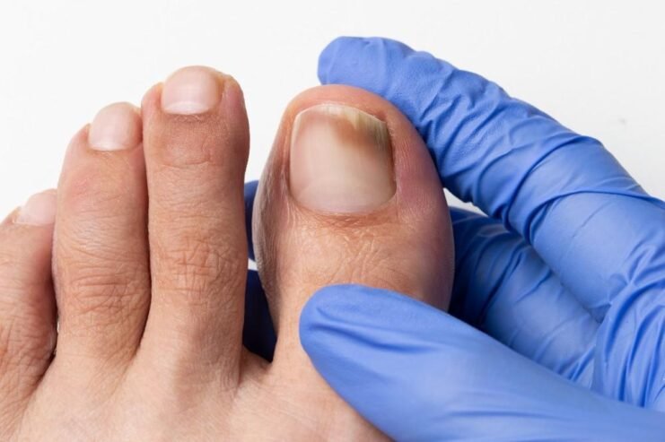 Effective Laser Treatment for Nail Fungus in GC, No Side Effects