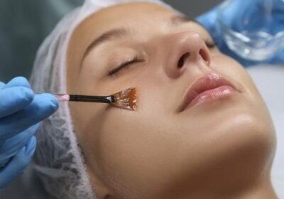Chemical-Peel