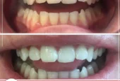 LED Teeth Whitening | Miami Kiss International