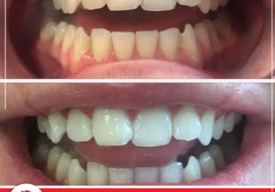 Miami-Kiss-before-after-teeth-whitening-01
