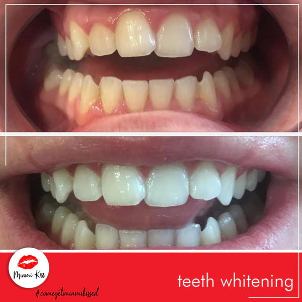 LED Teeth Whitening | Miami Kiss International